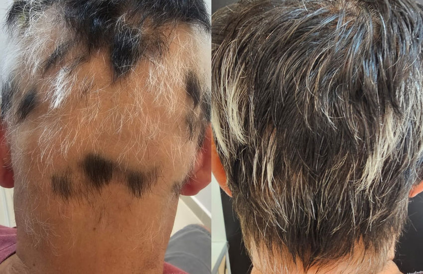 Resultado de transplante capilar focado em naturalidade