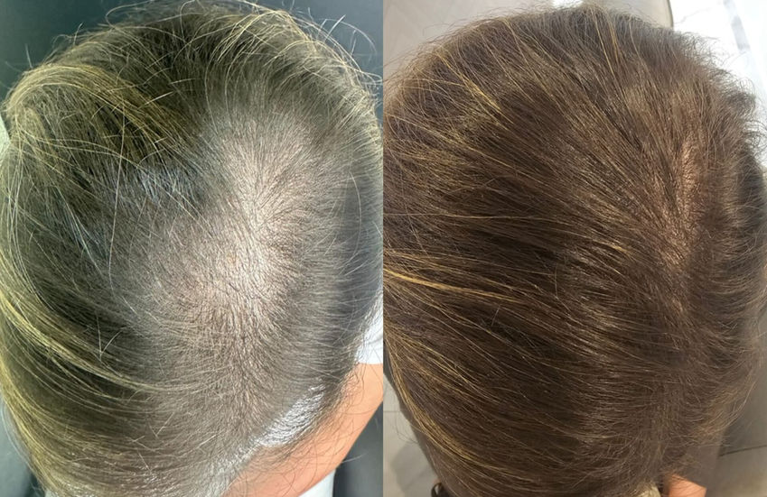 Resultado de tratamento capilar — antes e depois, região do topo do couro cabeludo