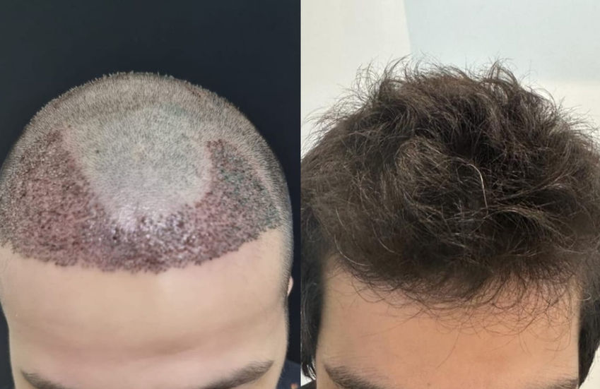 Resultado de tratamento capilar — antes e depois