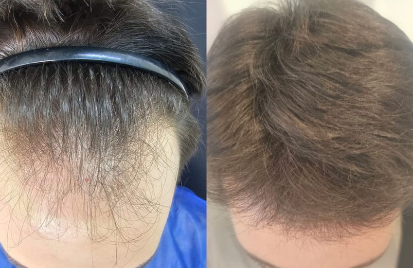 Resultado de tratamento capilar — antes e depois, linha frontal